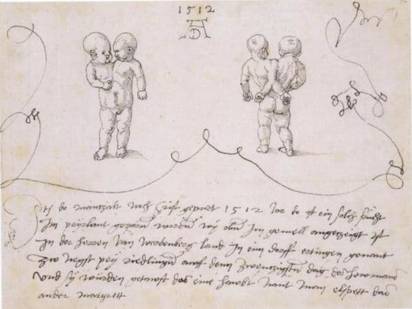 The Ertingen Siamese Twins